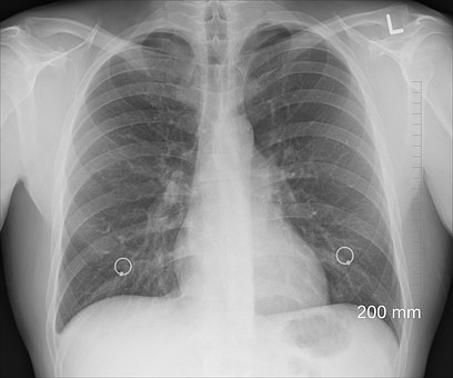 Lung disease is a common complication in RA patients