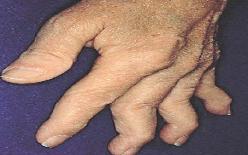 Rheumatoid arthritis is not ‘normal’ wear and tear of the joints